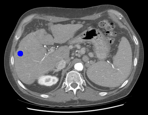 CT scan of hepatocellular carcinoma